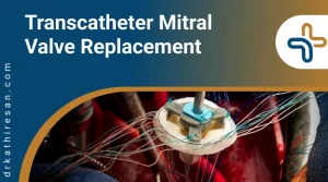 Transcatheter mitral valve replacement