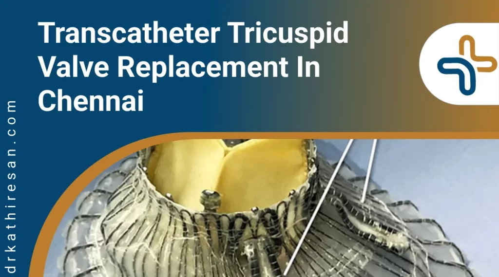 transcatheter tricuspid valve replacement in Chennai