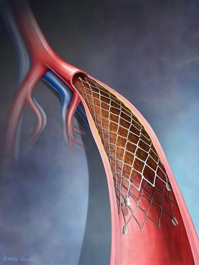 Know Everything about Primary Angioplasty
