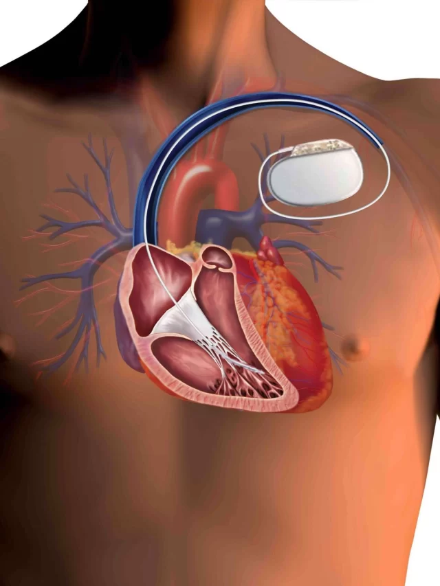 Which is Better: Single or Dual Chamber Pacemaker?