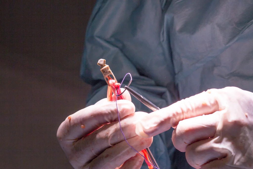 bifurcation stenting in chennai