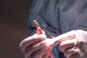 bifurcation stenting in chennai