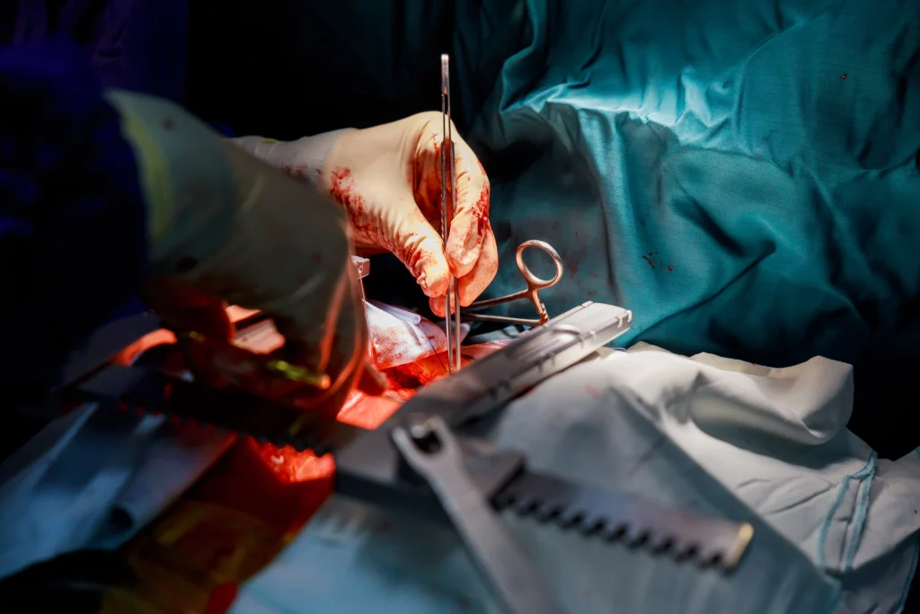 Complex and Advanced Angioplasty in chennai