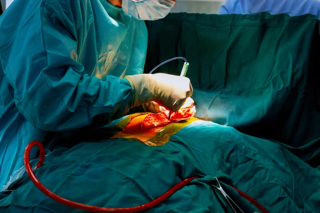 Transcatheter Aortic Valve Replacement In Chennai