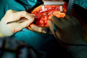 Transcatheter Tricuspid Valve Replacement in chennai