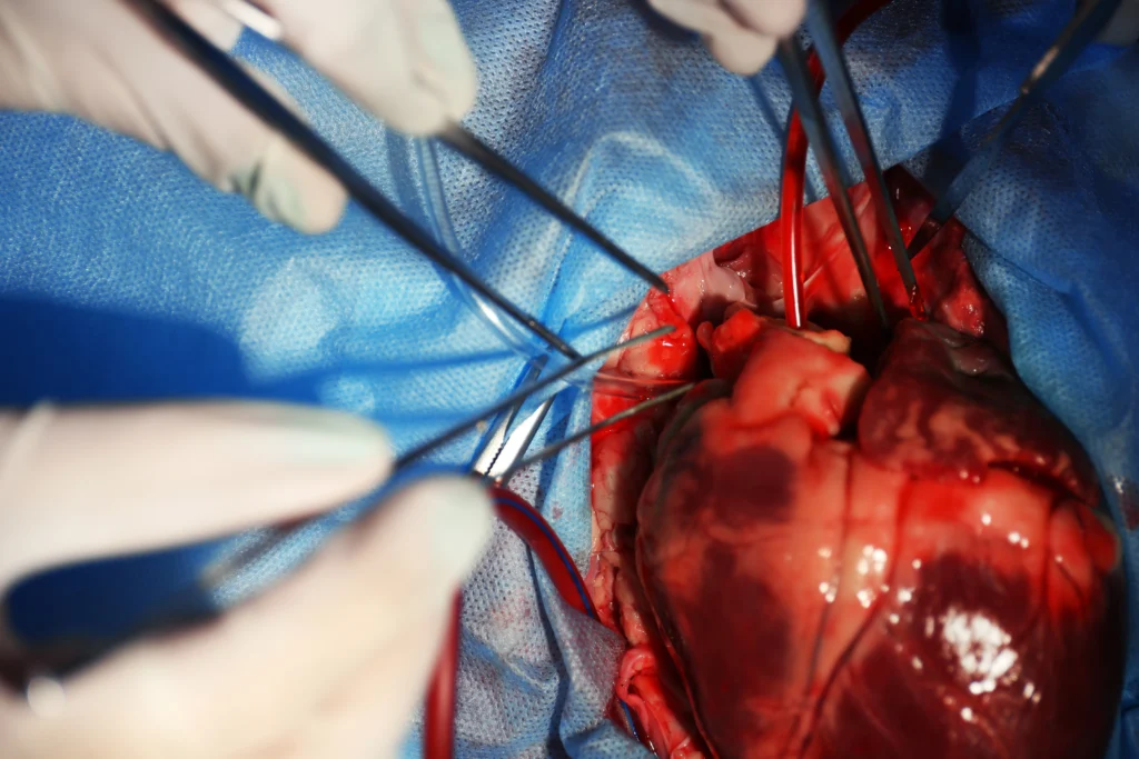 Endovascular Aortic Aneurysm Repair in chennai