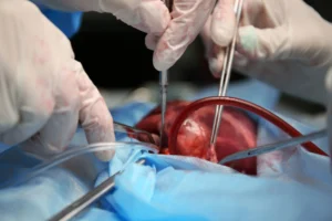 Transcatheter Mitral Valve Replacement In Chennai
